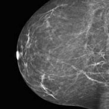 Stanford Health Care Offers Tomosynthesis Screening for Breast Cancer Diagnosis - KGOTV
