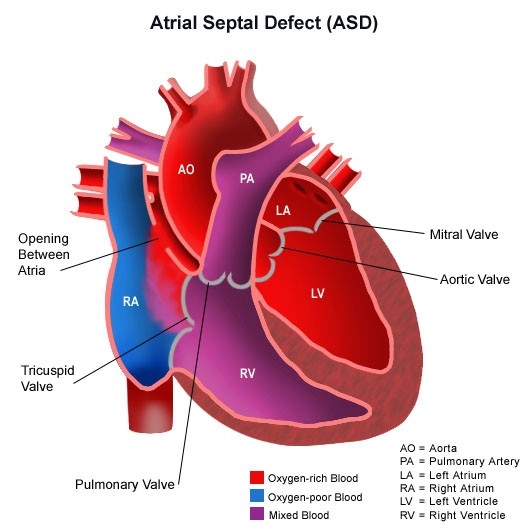congenitalheartdisease-diagram-heartatrialseptaldefect.jpg