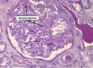 Amyloid deposits in the kidneys