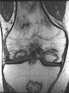 MRI scan showing osteonecrosis of the knee.