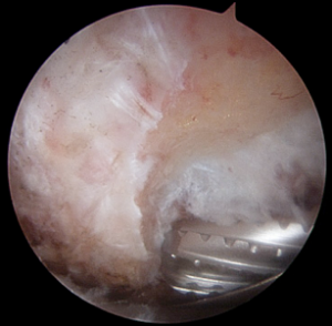 Scope image of shoulder surgery. 