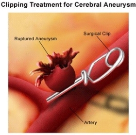 Clipping treatment for cerebral aneurysm