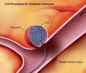 Coil procedure for cerebral aneurysm