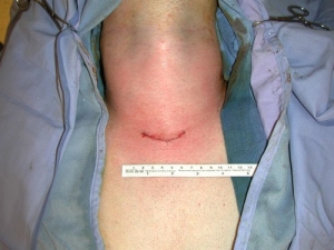 skin incision for transcervical thymetomy