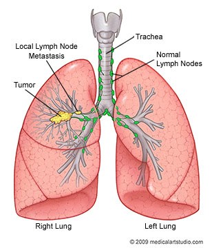 Diagram of lung tumor