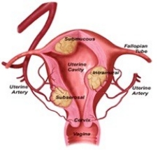 Uterine Fibroid Embolization (UFE)