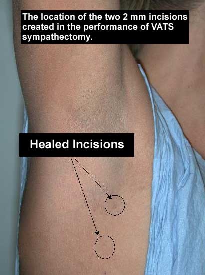 image of healed incisions after VATS sympathectomy